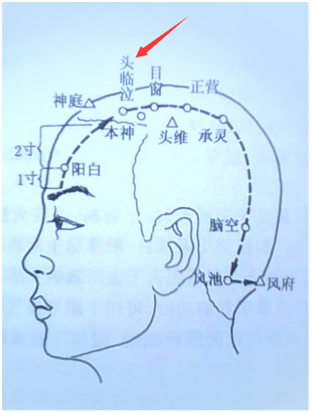 圣透灸-15头临泣穴